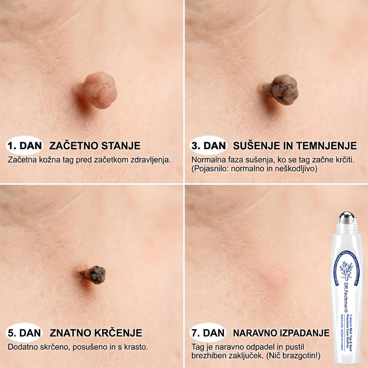 🌿DR.Fachmer®👩‍⚕️ Rezultati so vidni že v 7 dneh! Valjček za odstranjevanje bradavic in drugih kožnih težav | Neboleče in minimalno razmaže. 🌿