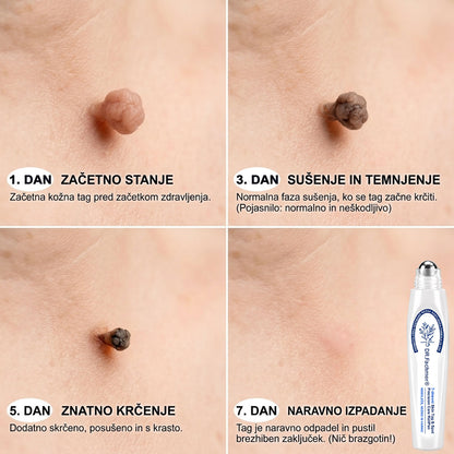 🌿DR.Fachmer®👩‍⚕️ Rezultati so vidni že v 7 dneh! Valjček za odstranjevanje bradavic in drugih kožnih težav | Neboleče in minimalno razmaže. 🌿