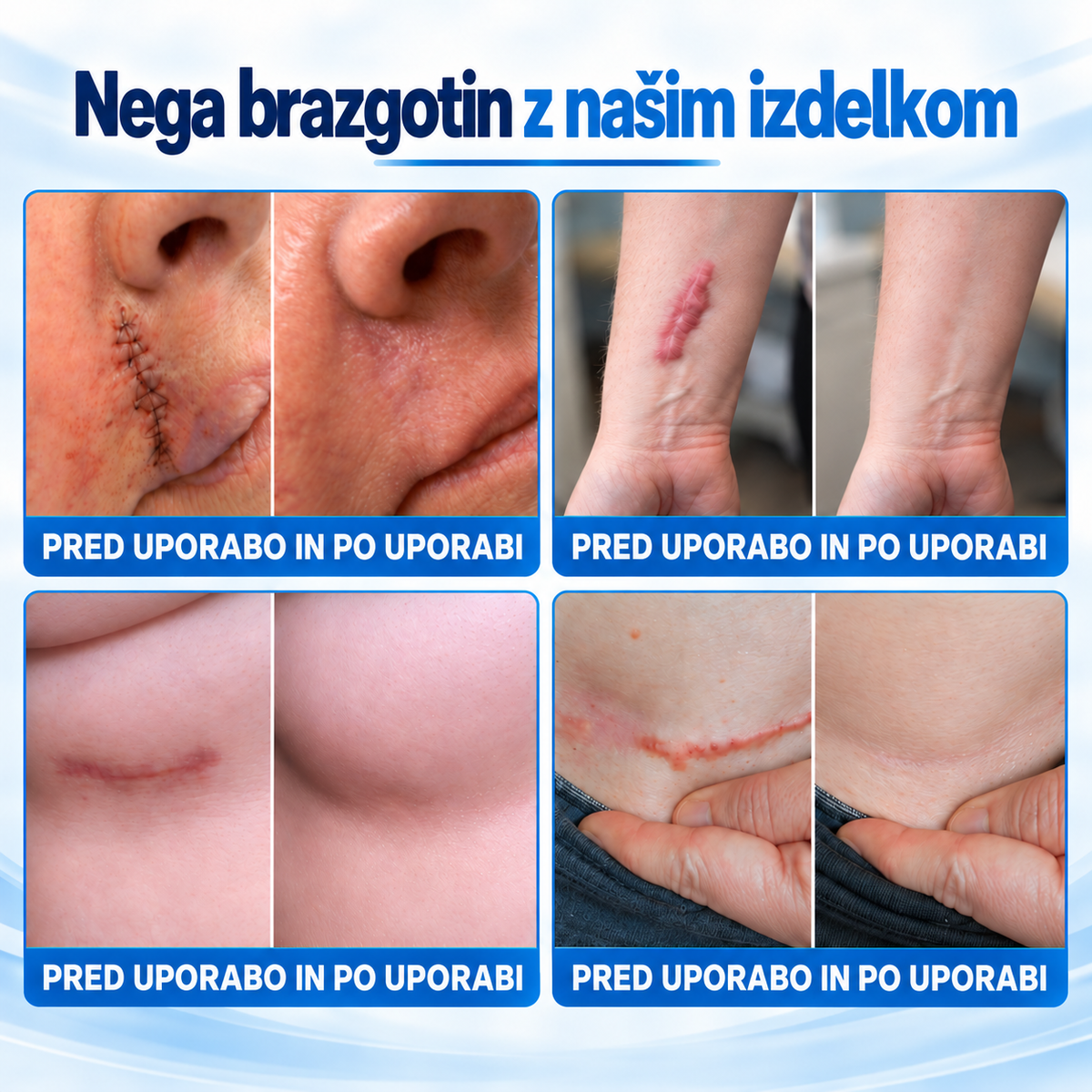 Dr.Fachmer® 🏆 Bio-regenerativni mikroiglični obliž za brazgotine – silikonska nega brazgotin z obnovitvenimi proteini