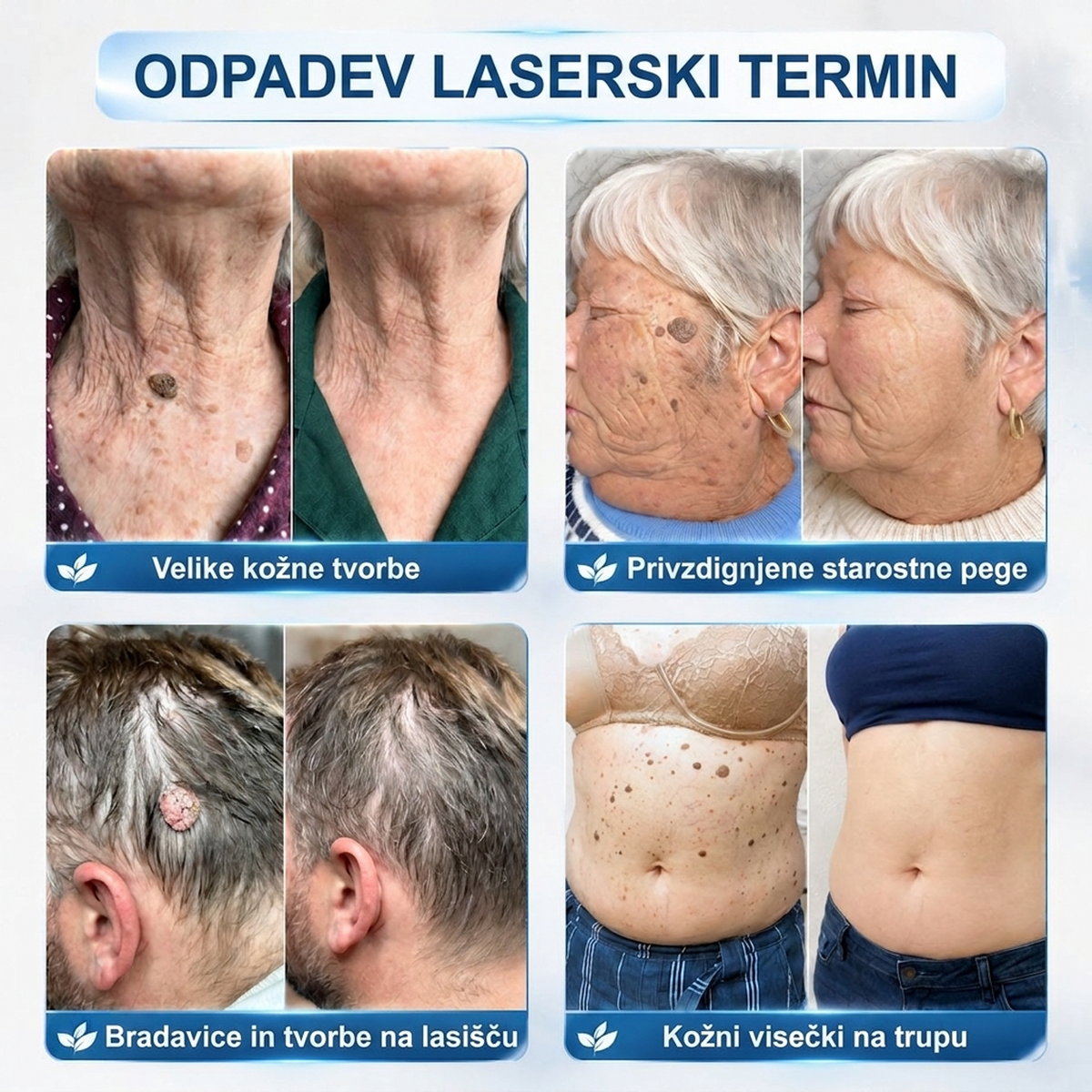 🌿DR.Fachmer®👩‍⚕️ Rezultati so vidni že v 7 dneh! Valjček za odstranjevanje bradavic in drugih kožnih težav | Neboleče in minimalno razmaže. 🌿