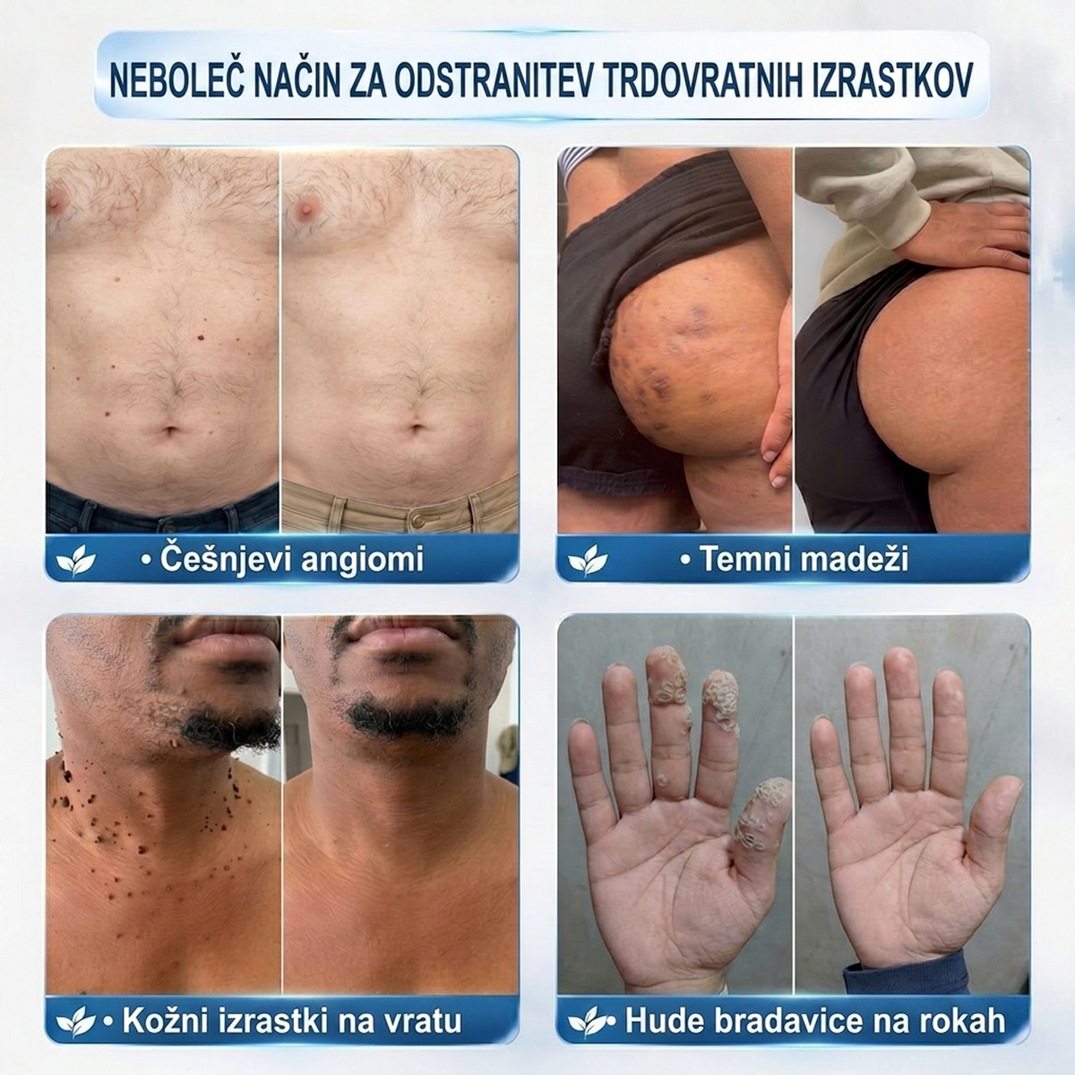 🌿DR.Fachmer®👩‍⚕️ Rezultati so vidni že v 7 dneh! Valjček za odstranjevanje bradavic in drugih kožnih težav | Neboleče in minimalno razmaže. 🌿