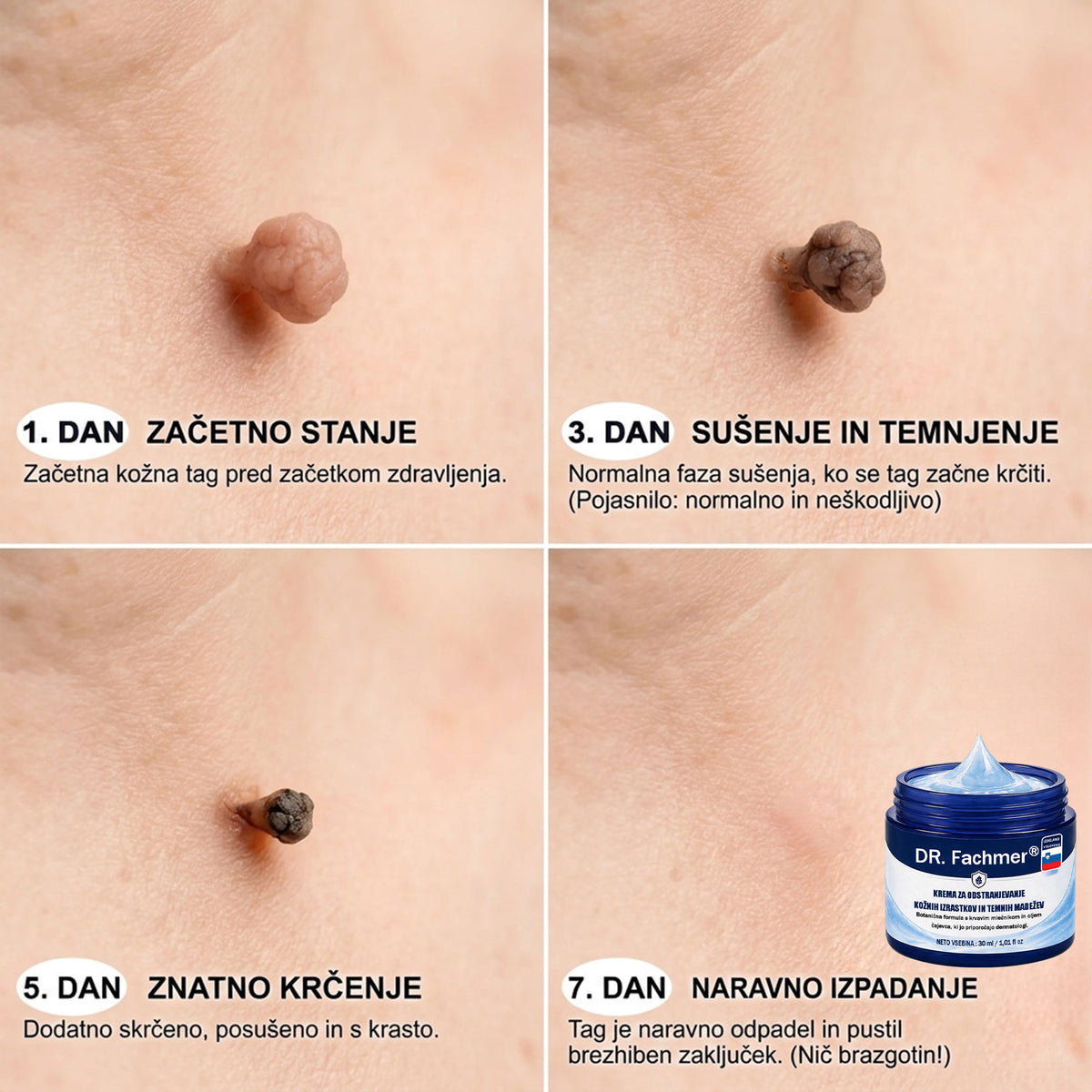 🥇❤️ DR.Fachmer® Napredna Korektivna Krema za Kožne Izrastke, Madeže in Pigmentne Nepravilnosti – 7 Dni Brez Bolečin in Brez Brazgotin – Napredna Nega Kožnih Nepravilnosti