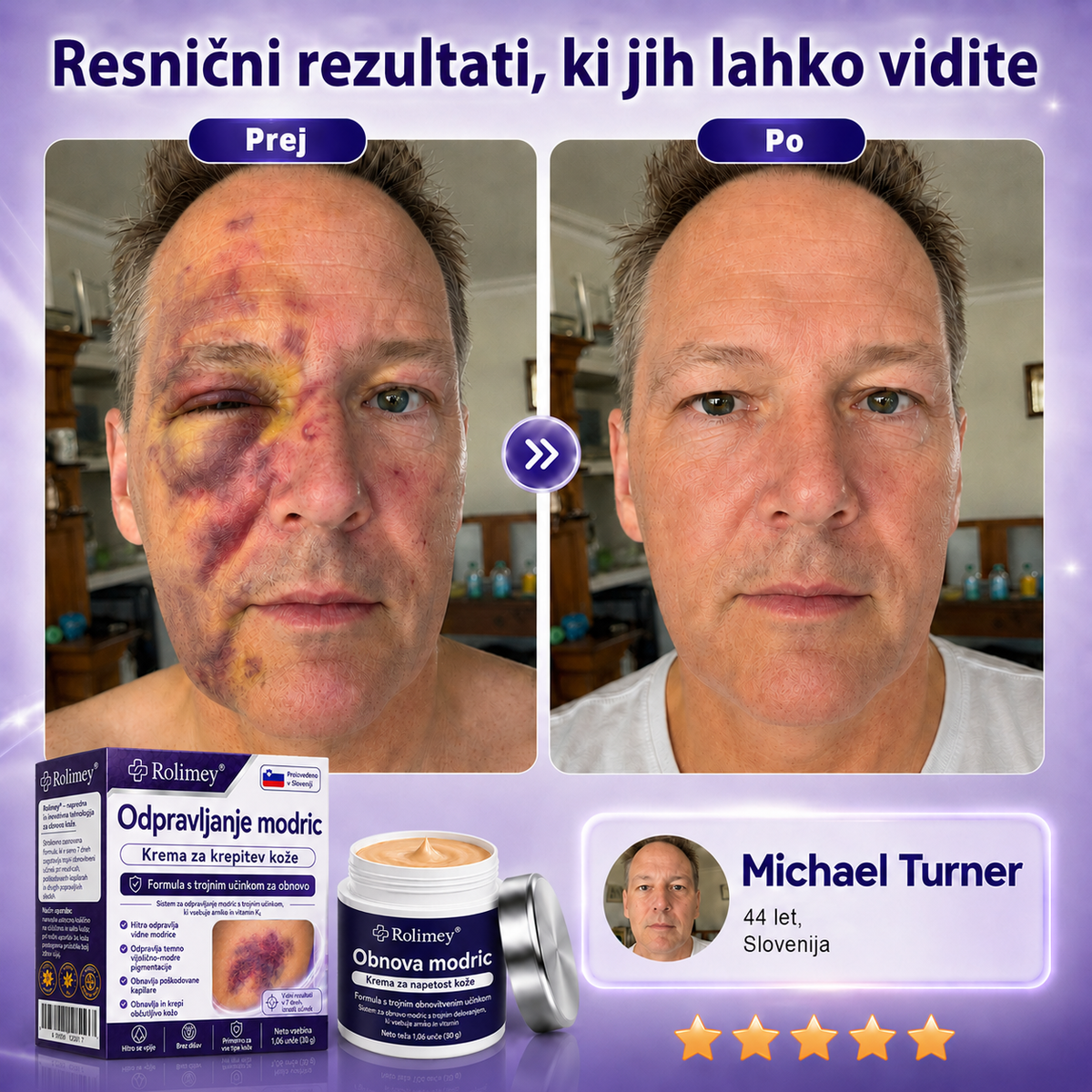 🏆100K+ PRODAJ 💁‍♀️ – Rolimey® Krema za obnovo modric in krepitev kože