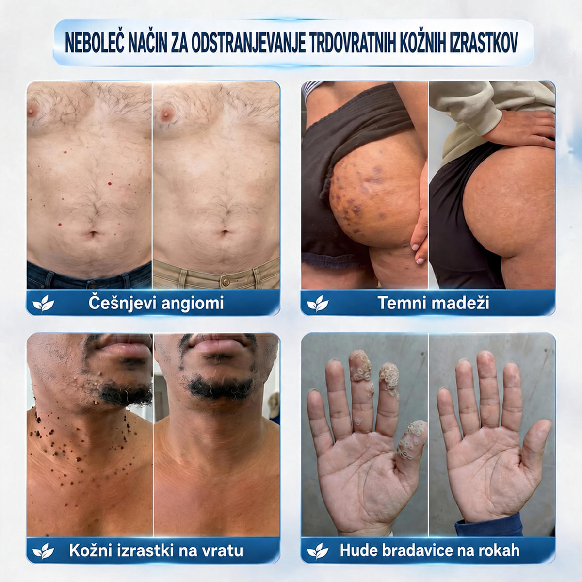 🥇❤️ DR.Fachmer® Napredna Korektivna Krema za Kožne Izrastke, Madeže in Pigmentne Nepravilnosti – 7 Dni Brez Bolečin in Brez Brazgotin – Napredna Nega Kožnih Nepravilnosti