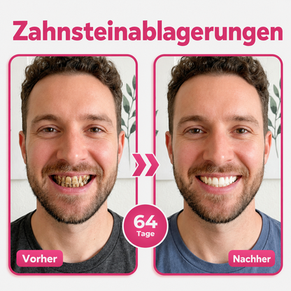 DR.Fachmer® Thismile NH-10 zobna pasta-serum za zobno sklenino in dlesni – napredna terapija