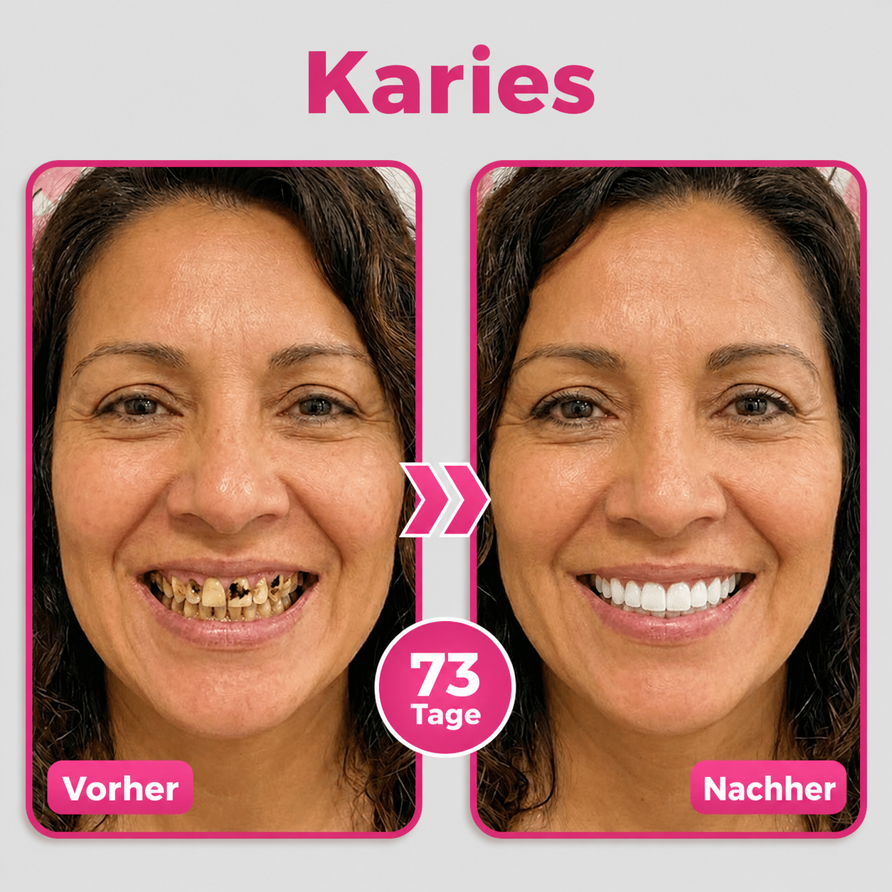 DR.Fachmer® Thismile NH-10 zobna pasta-serum za zobno sklenino in dlesni – napredna terapija