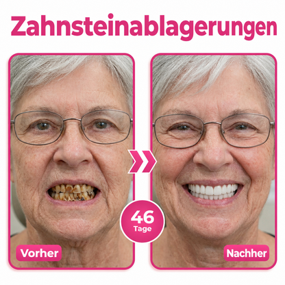 DR.Fachmer® Thismile NH-10 zobna pasta-serum za zobno sklenino in dlesni – napredna terapija